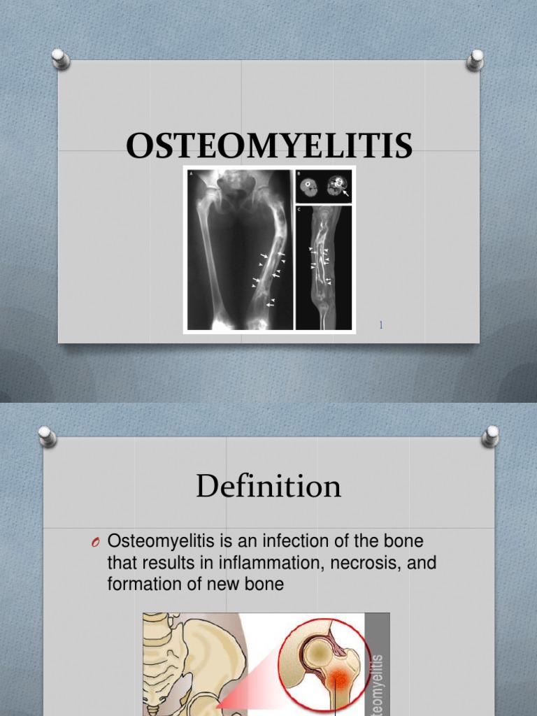 Osteomyelitis PDF Infection Surgery