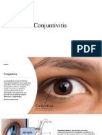 Conjuntivitis