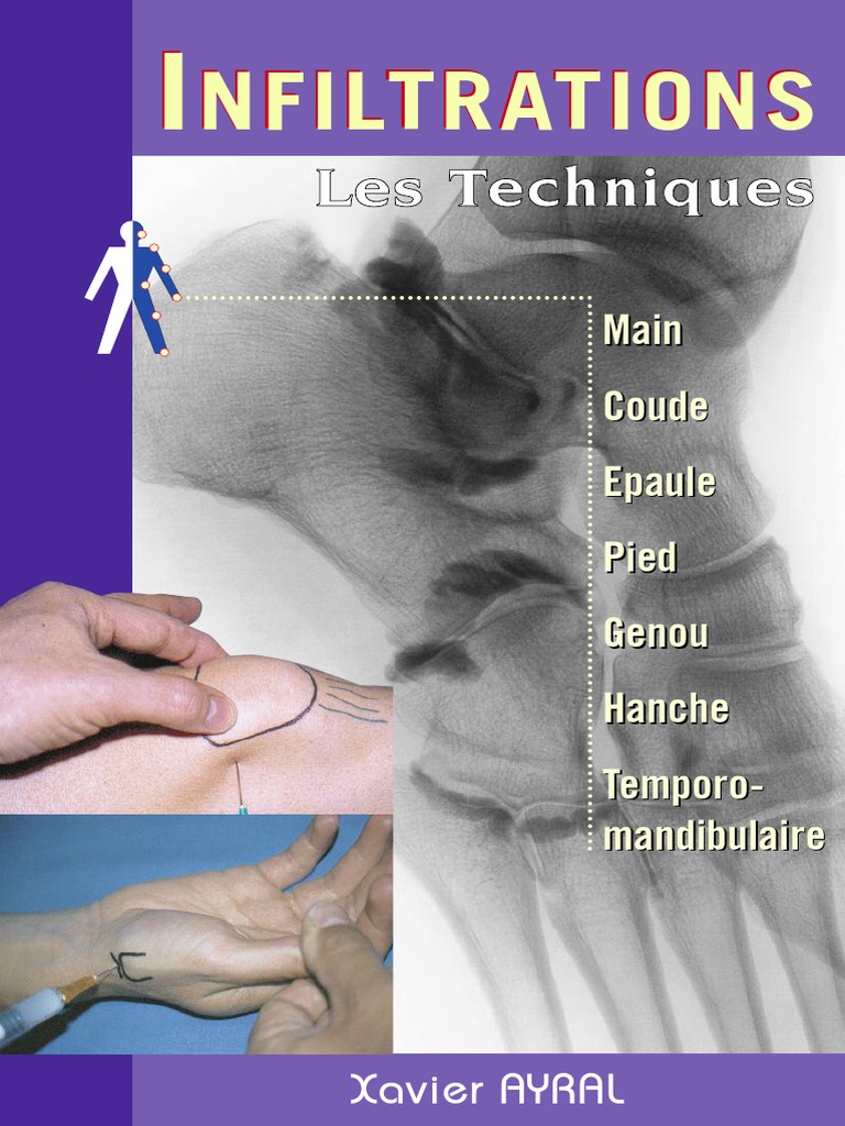 Image: Radiographie du genou dans l'arthrose - Édition professionnelle du  Manuel MSD