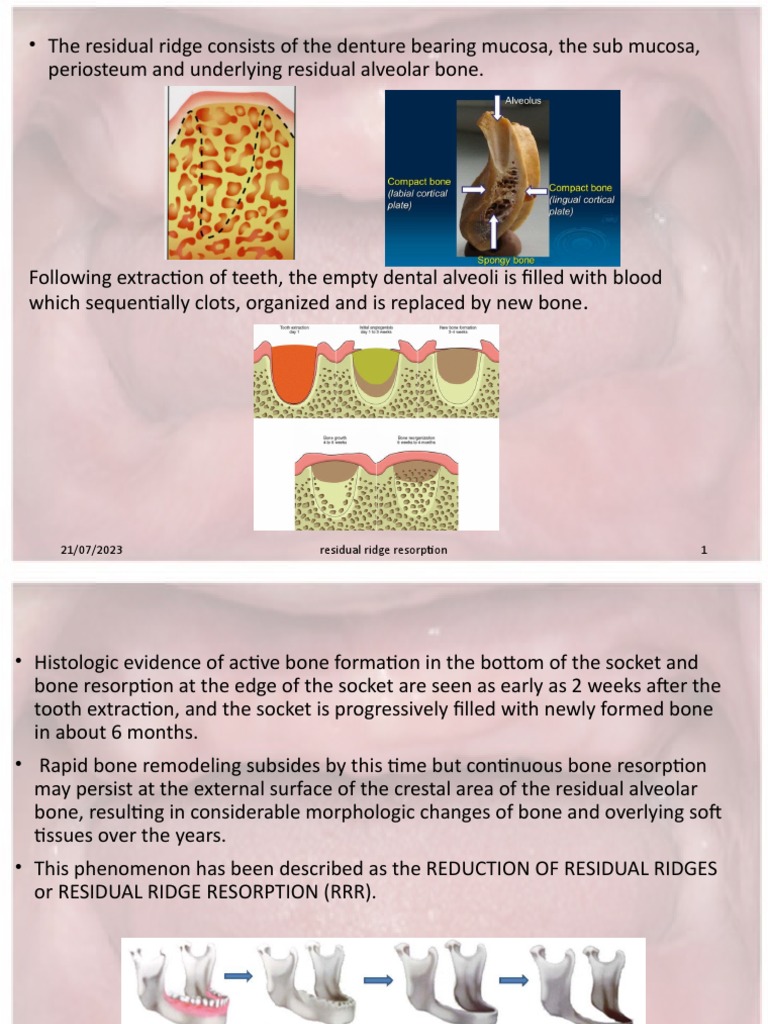 Residual Ridge Resorption Factors | PDF | Dentures | Dental Implant
