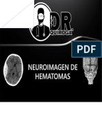 HEMATOMAS EPIDURAL E SUBDURAL DR QUIROGA