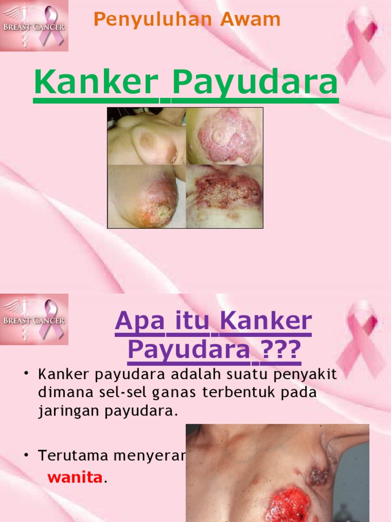 Kanker Payudara | PDF