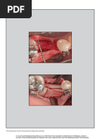 Rapid Orthodontic Treatment After The Ridge-Splitting Technique