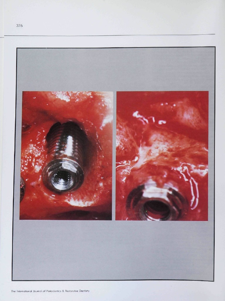 Guided Tissue Regeneration For Implants Placed Into Extraction Sockets