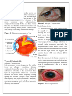 Conjunctivitis