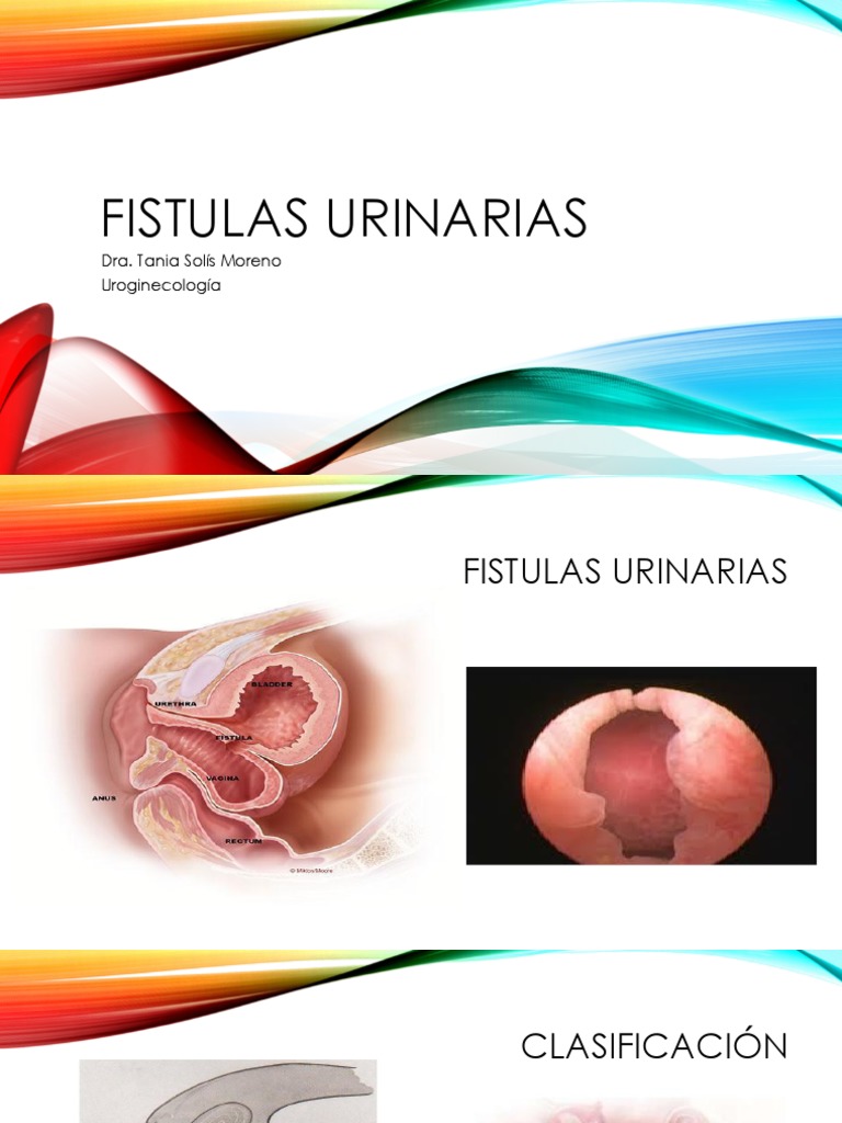 fistulas-urinarias-dra-tania-sol-s-moreno-uroginecolog-a-pdf