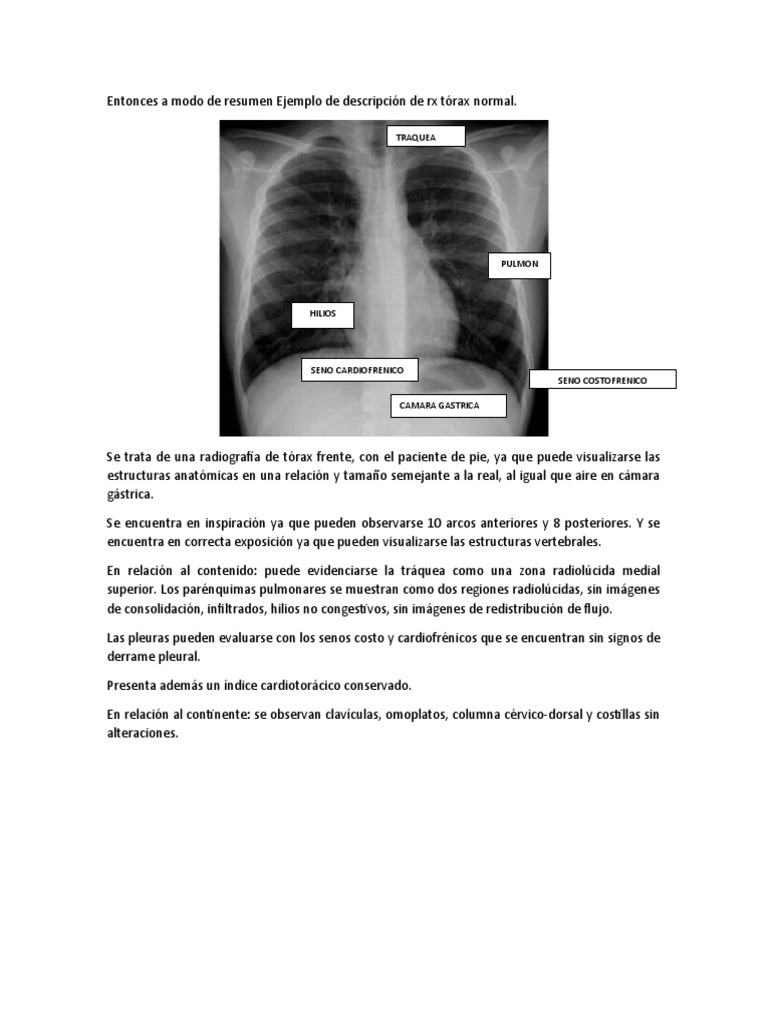 Descripción de RX de Tórax Normal | PDF