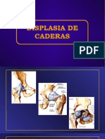 Displasia de Cadera