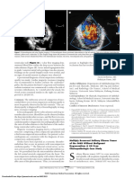 Multiply Recurrent Solitary Fibrous Tumor of The Orbit Without Malignant Degeneration - A 45-Year Clinicopathologic Case Study
