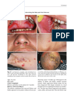 4.1 Pemphigus: Case 38 Pemphigus Vulgaris (Involving The Skin and Oral Mucosa) B