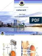 Cataract