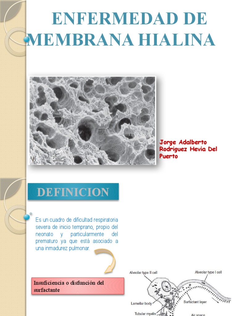 enfermedad de mémbrana hialina PDF Parto prematuro Enfermedades y trastornos humanos