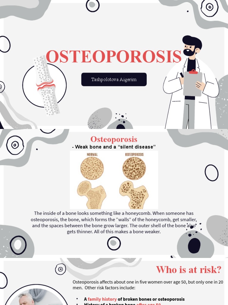 Osteoporosis Aigerim | PDF | Osteoporosis | Bone