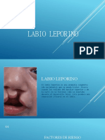 Labio Leporino
