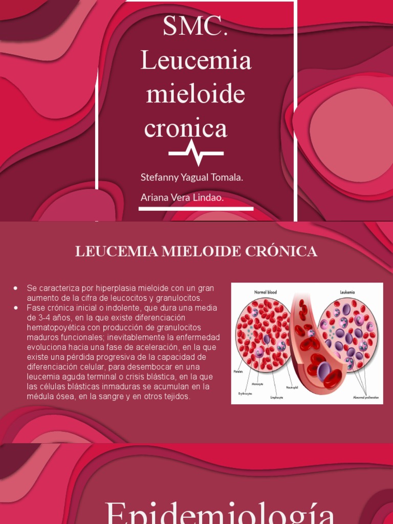 Leucemia Mieloide Cronica PDF