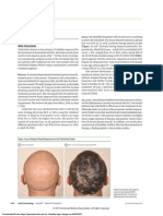 Tafacitinid en Alopecia Areata 2017