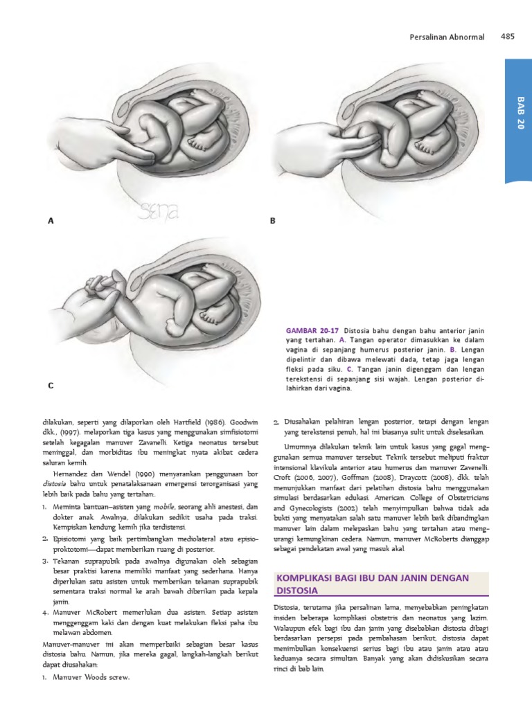 Simfisiotomi dan Manuver Rubin dalam Distosia | PDF | Sains & Matematika