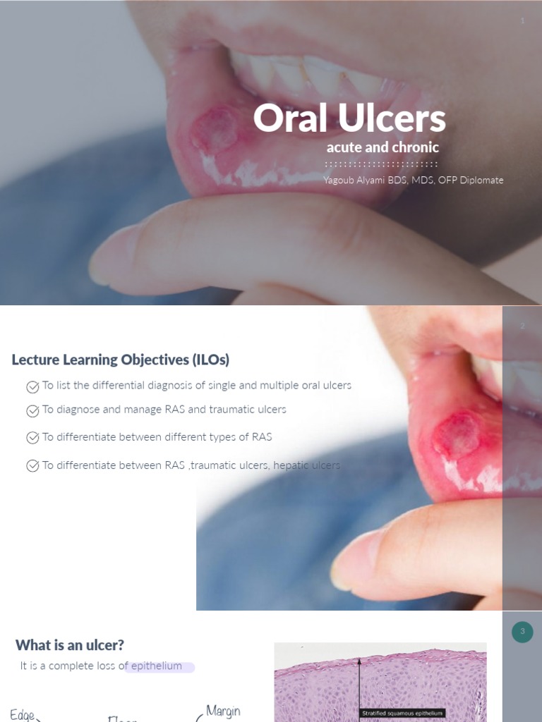Types and Management of Oral Ulcers | PDF | Gastroenterology | Immunology