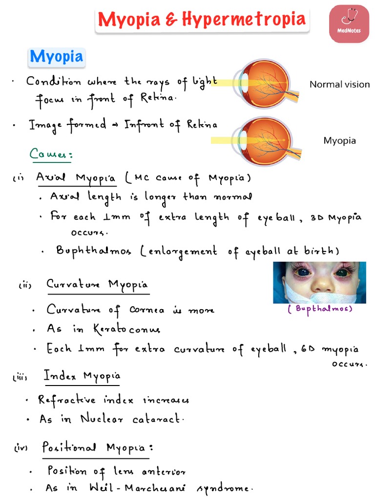 Myopia - Hypermetropia | PDF