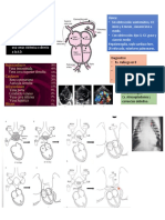 Drenaje Anómalo de Venas Pulmonares (DAVP)