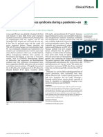 Acute Respiratory Distress Syndrome During A Pande