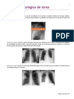 NE Radiologia Patologica de Torax