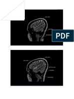 MRI BRAIN Sagittal View