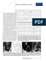 A Young Man With Palpitations and Ebstein's Anomaly of The Tricuspid Valve