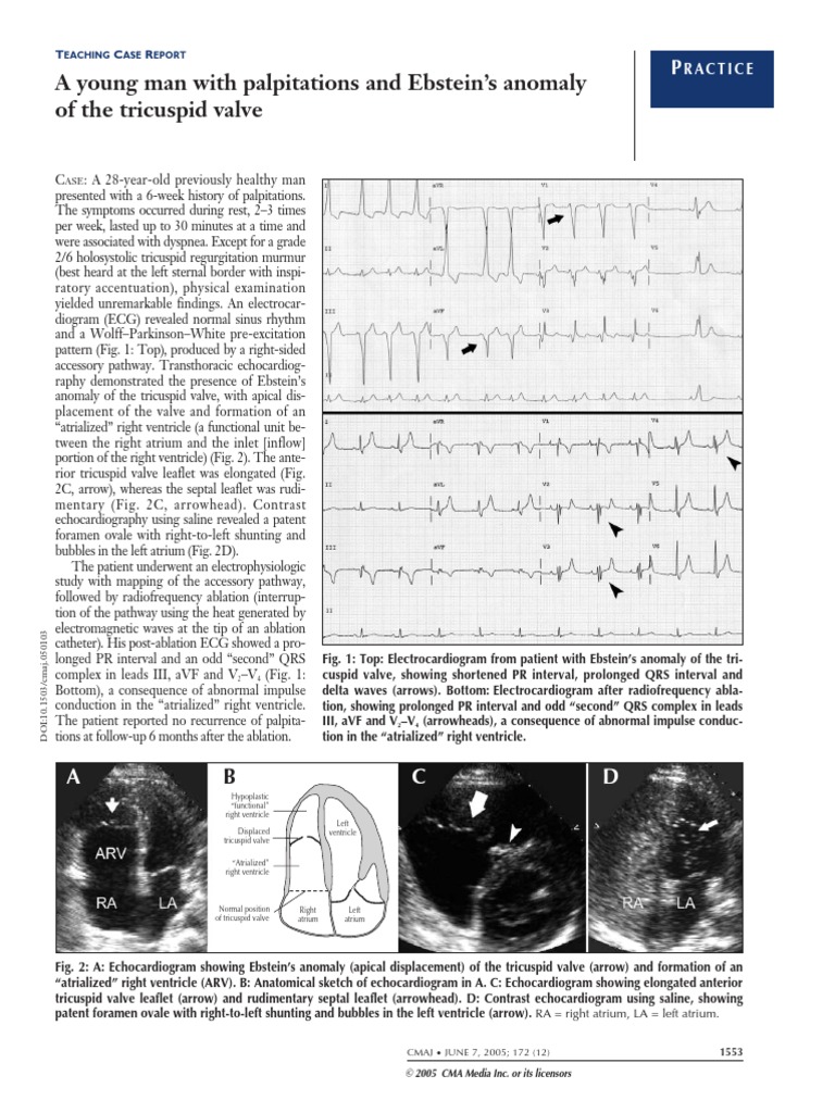 A Young Man With Palpitations and Ebstein's Anomaly of The Tricuspid