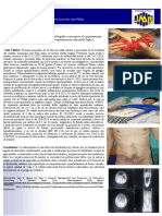 Perforación Duodenal Tífica