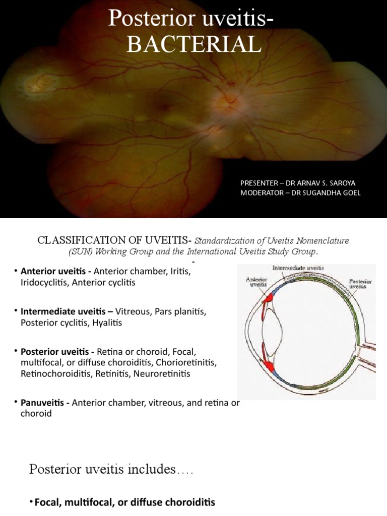 Bacterial Uveitis DR Arnav PDF Lyme Disease Tuberculosis