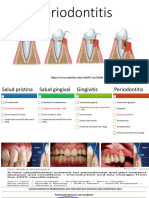 Periodontitis Abril 2023