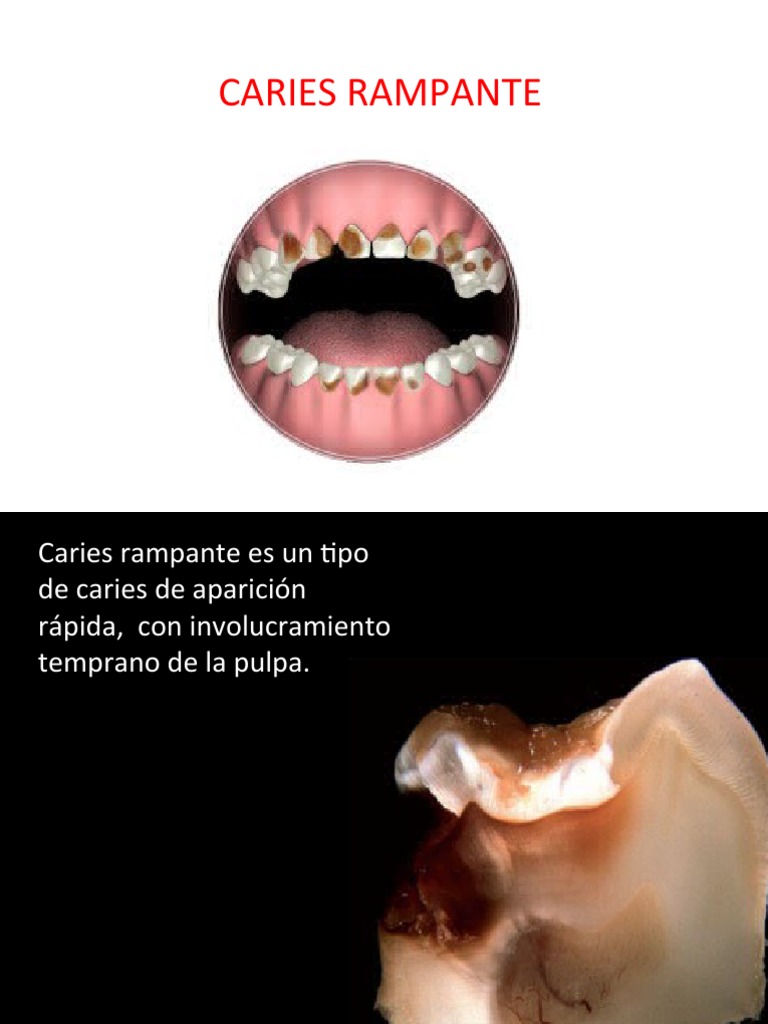 Caries Rampante Apunte Unap | PDF | Odontología | Diente