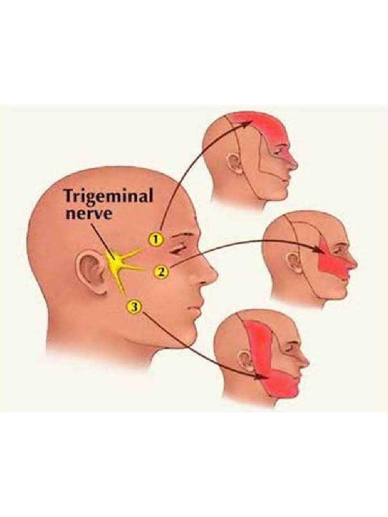Trigeminal Nevralji | PDF