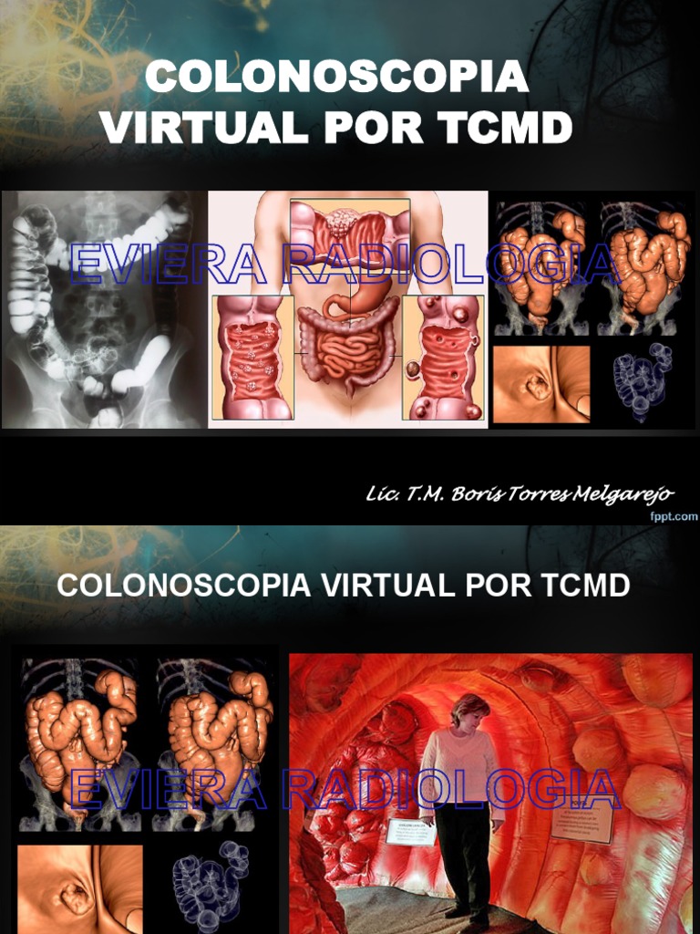 Colonoscopia Virtual | PDF | Cáncer colonrectal | Epidemiología
