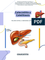Colecistitis y Colelitiasis