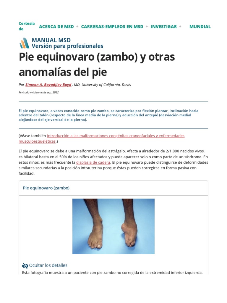 Pie Equinovaro (Zambo) y Otras Anomalías Del Pie Pediatría Manual