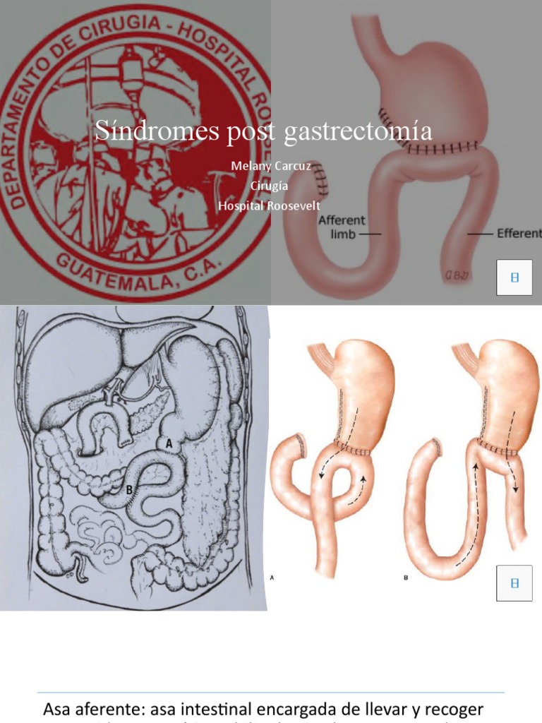 Síndromes Postgastrectomía y Anastomosis | PDF | Endoscopia | Medicina ...