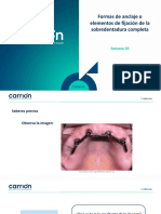 PSA5 PD II Sobredentadura Completa