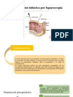 Esterilización Tubárica Por Laparoscopía