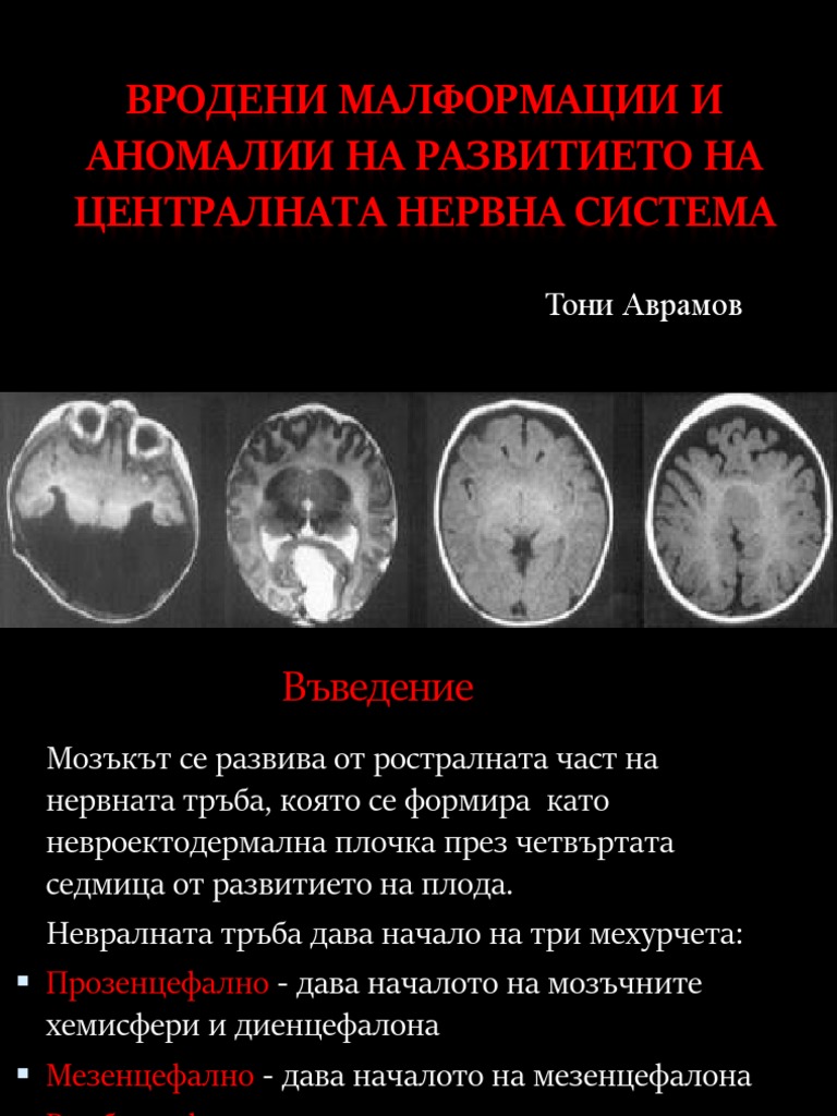 Вродени малформации и аномалии на развитието на | PDF