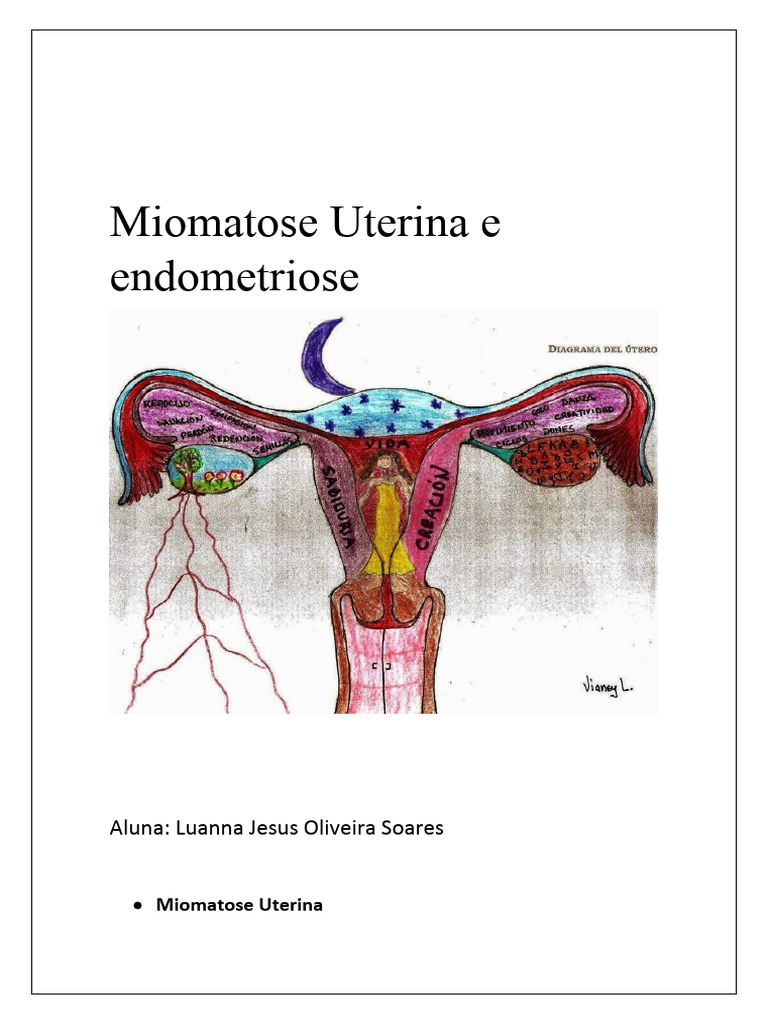 Miomatose Uterina e Endometriose | PDF | Reprodução humana | Doenças e ...