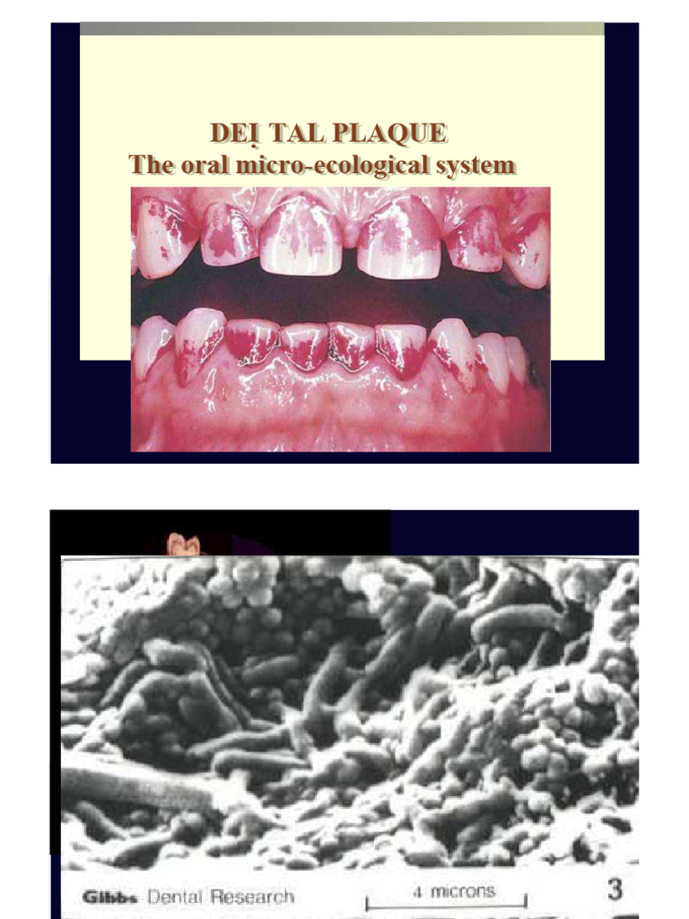 2.LOCAL PLAQUE and PLAQUE RETENTIVE FACTORS. 2013ppt Download Free