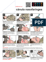 Inserción Cánula Nasofaríngea