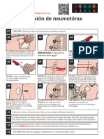 Decomprescion de Neumotorax A Tension