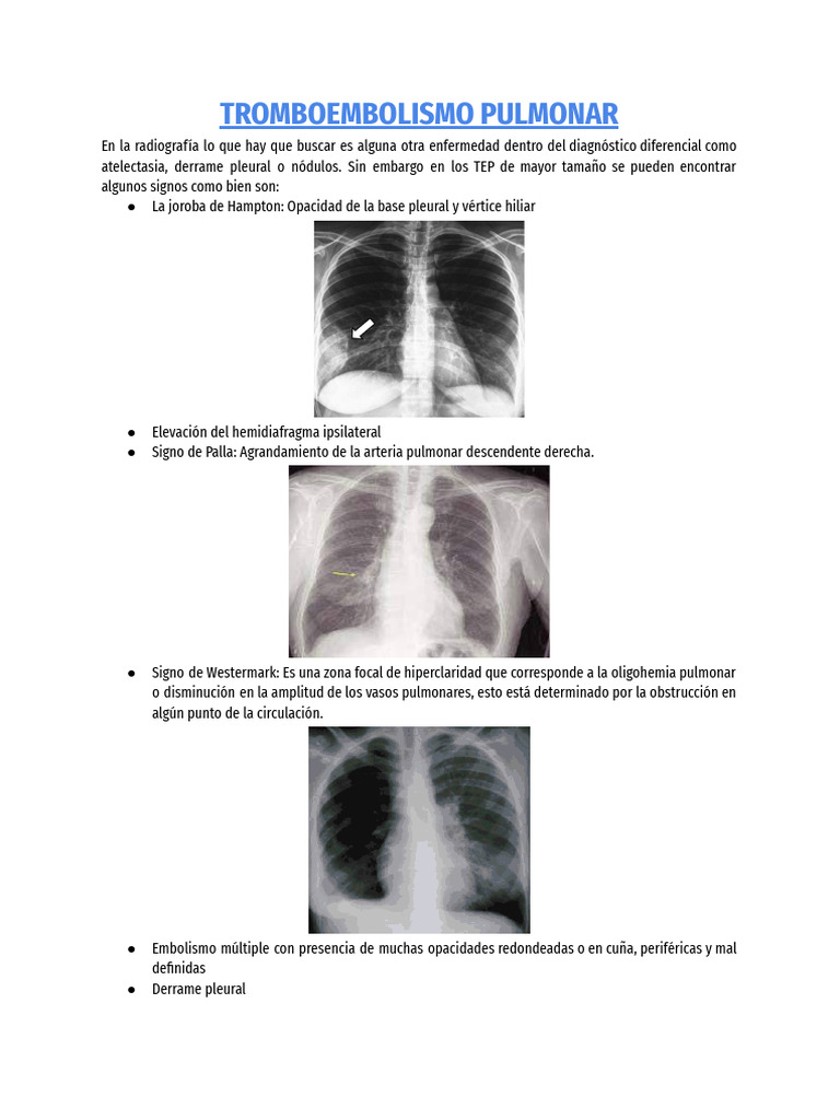 Tromboembolismo Pulmonar | PDF | Electrocardiografia | Pulmón