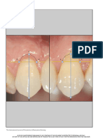 A Technique To Identify and Reconstruct The Cementoenamel Junction Level