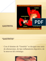 GASTRITIS