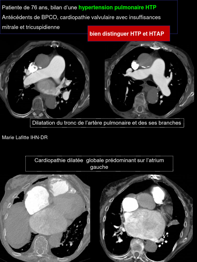 Dilatation du tronc pulmonaire et HTP | PDF | Vaisseau sanguin | Poumon