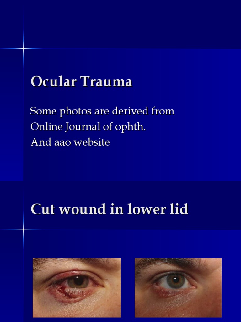 Ocular Trauma: Types and Treatments | PDF